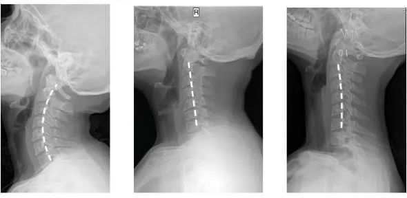 拯救颈椎神器颈椎枕,保护颈椎神器推荐