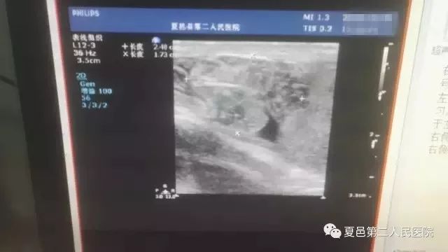 睾丸蒂扭转不治疗会一直肿吗,睾丸扭转如何避免