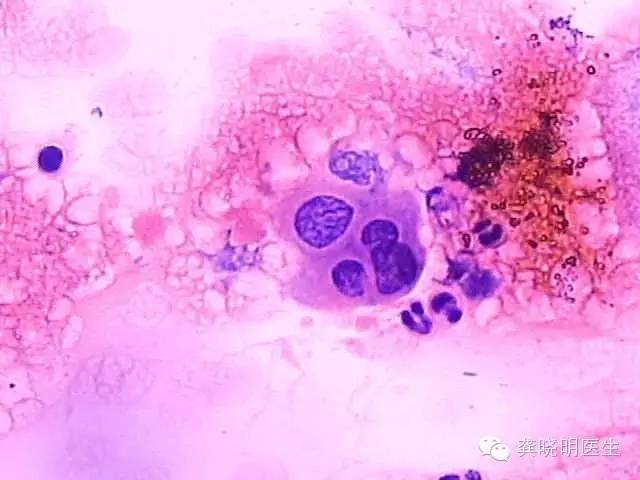 如何看懂宫颈刮片检验单,宫颈刮片报告怎么看