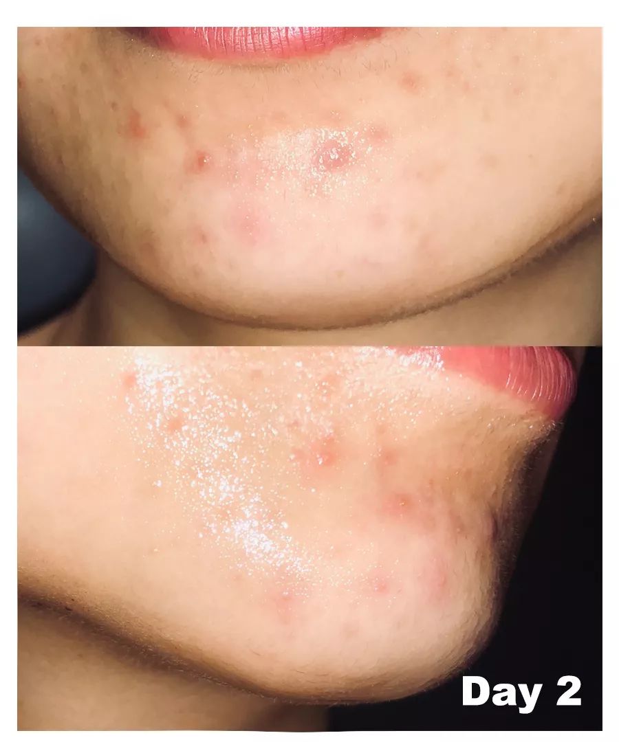 怎么对付闭口,终于找到了对抗失眠的良方