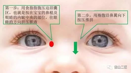 宝宝泪道探通后流血水,两岁宝宝流脓鼻涕流眼泪