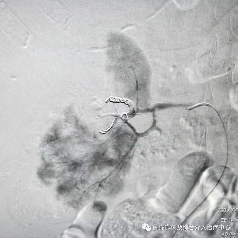 运城市第一医院肿瘤科咋样,运城第一医院治疗肿瘤怎么样