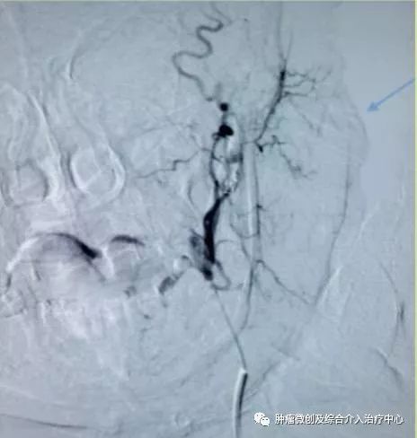 运城市第一医院肿瘤科咋样,运城第一医院治疗肿瘤怎么样