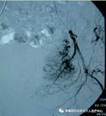 运城市第一医院肿瘤科咋样,运城第一医院治疗肿瘤怎么样
