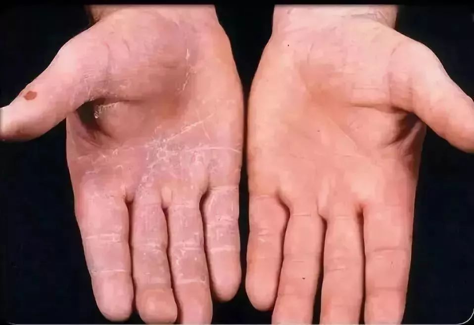 猫癣传染了给人该怎么办,人被传染上猫癣能用皮特芬吗