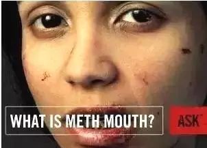 吸毒的牙齿是什么样子的,吸毒牙齿脱落