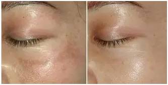 激光美容技术有用吗,解读激光美容的六大疑惑