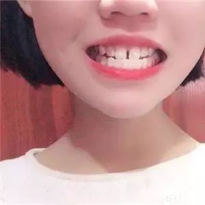 种植牙能降价多少钱啊,牙齿种植牙价格一览表