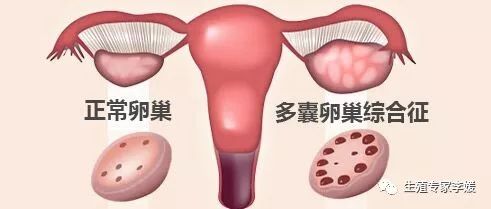 闭经如何补充雌激素,闭经如何处理