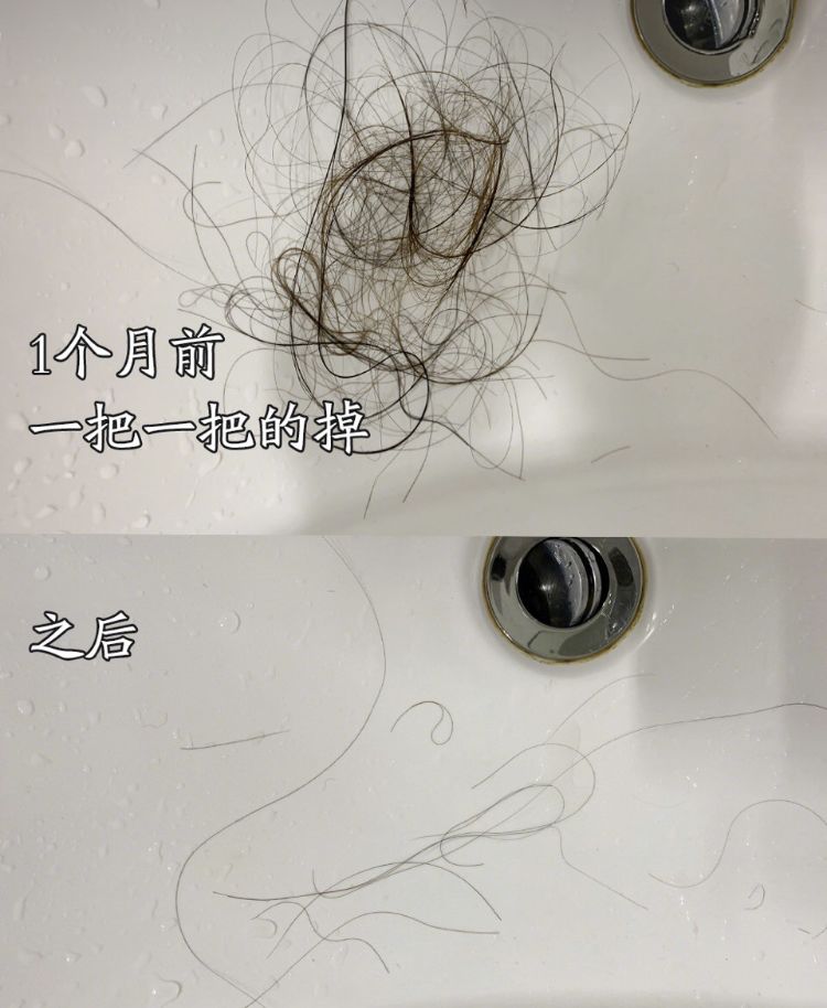 疯狂掉头发发际线后移,疯狂掉头发头发变得稀疏