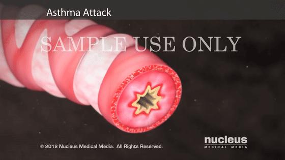 男子哮喘发作喘不过气,哮喘发作呼吸不顺畅