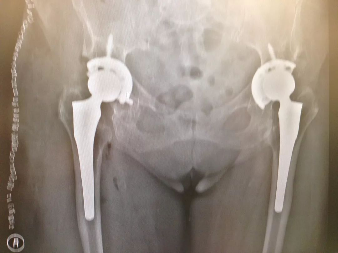 「筋骨堂」人工髋关节并非一劳永逸