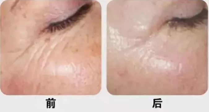 杨紫法令纹填充过多像小猴子,杨紫法令纹和嘴角纹怎么这么深