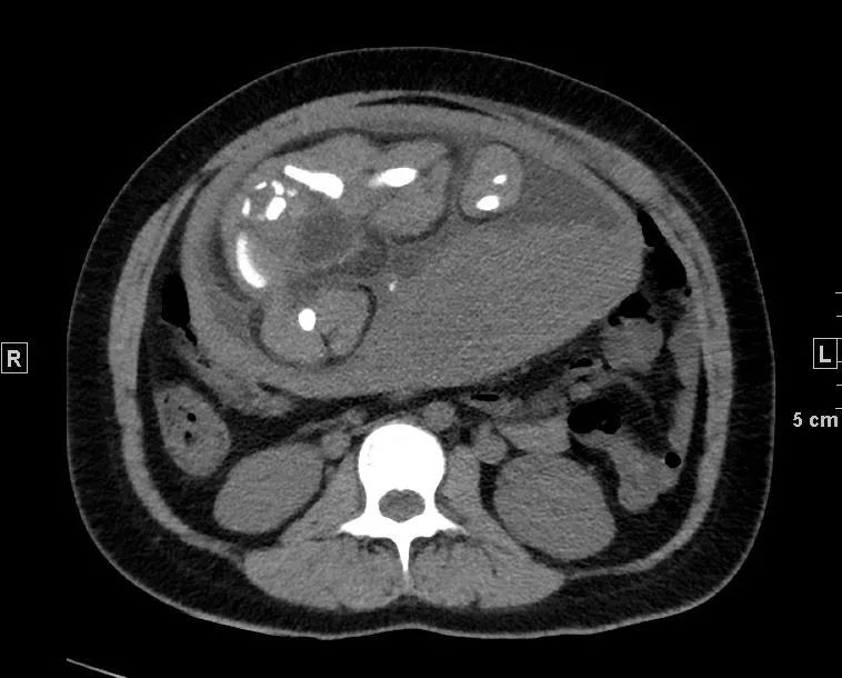 心冠动脉夹层能治愈吗,夹层动脉血管破裂症状