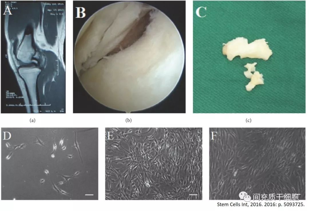 干细胞修复半月板损伤靠谱吗,中国哪里有干细胞治疗半月板损伤
