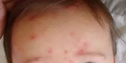 宝宝发高烧退烧后发生惊跳,宝宝输液反应发烧40度怎么办