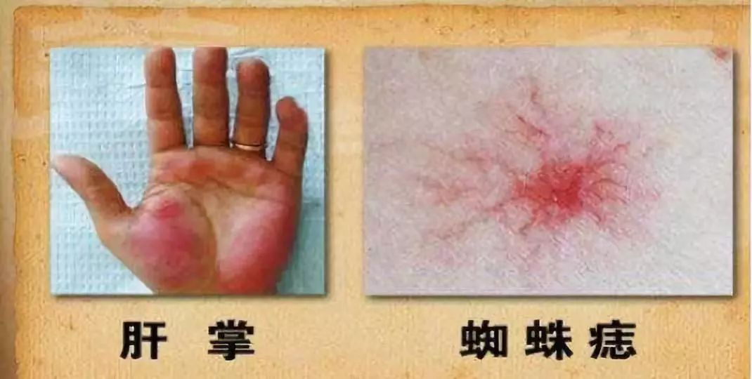 这种痣可能是肝癌信号,肝癌胸前小红痣样子