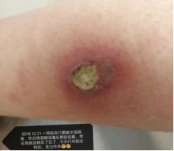 热水袋烧伤,热水袋烧伤起泡怎么处理