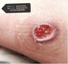 热水袋烧伤,热水袋烧伤起泡怎么处理