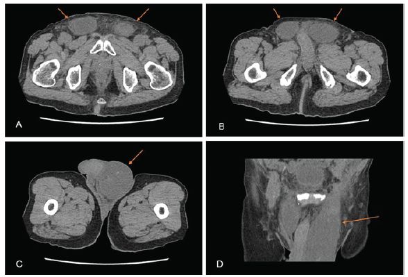 腹股沟修补后血肿硬的软的,腹股沟疝修补术后巨大血肿形成