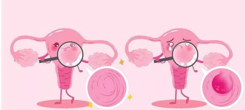 更年期出血要警惕,绝经后出血是子宫内膜癌的前兆吗