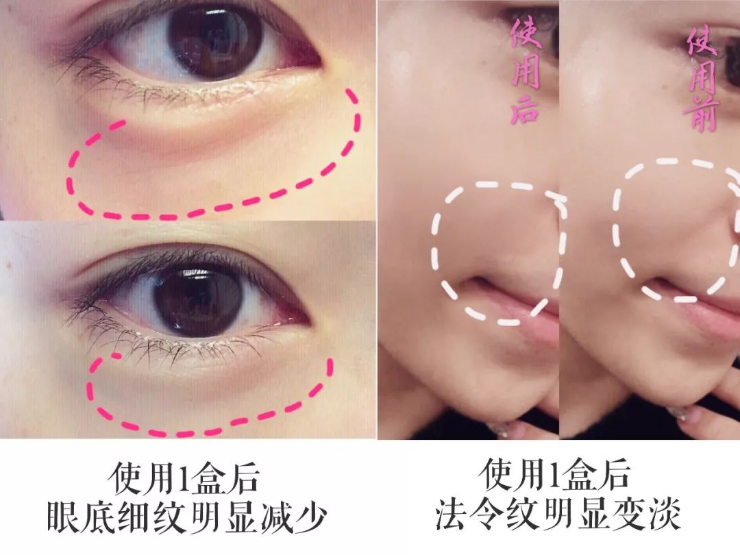 法令纹用一支玻尿酸够了没有,玻尿酸冻干眼纹贴