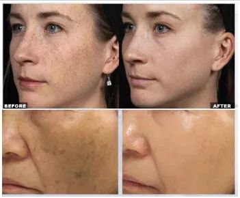 晒斑痘印去除土方法,5个祛斑小妙招淡化晒斑雀斑痘印