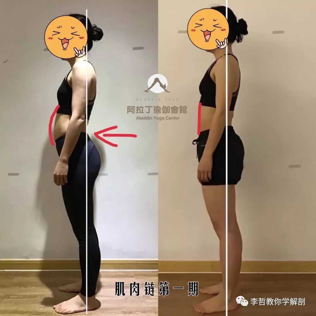 腰间盘突出脊柱侧弯康复训练,螺旋肌肉链训练治疗腰椎间盘突出