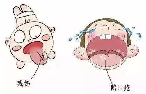 小儿鹅口疮的科普知识,怎么辨别宝宝得了鹅口疮