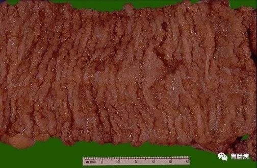 容易癌变的息肉有哪些,什么样子的息肉容易癌变