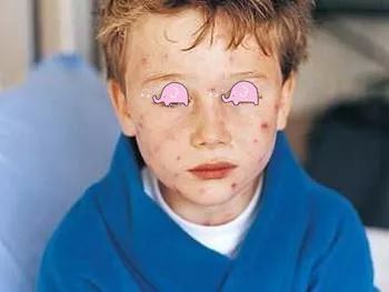 儿童季节性皮疹用什么药最好,儿童常见的出疹疾病