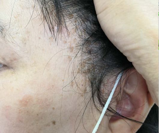 脱发属于什么问题,脱发是什么原因造成中老年