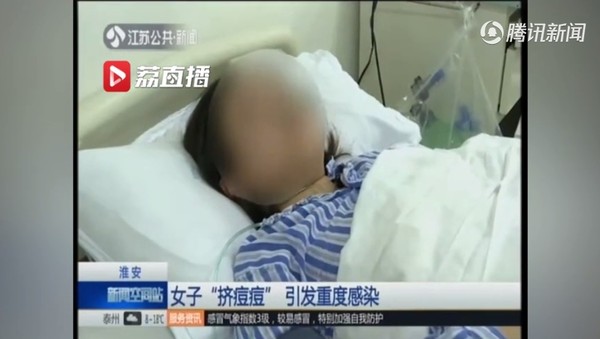 挤了人中的痘痘头晕,挤完人中痘痘后害怕颅内感染