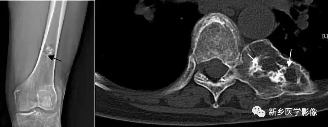骨骼疾病怎么调理最有效,骨骼坏死最佳治疗方法