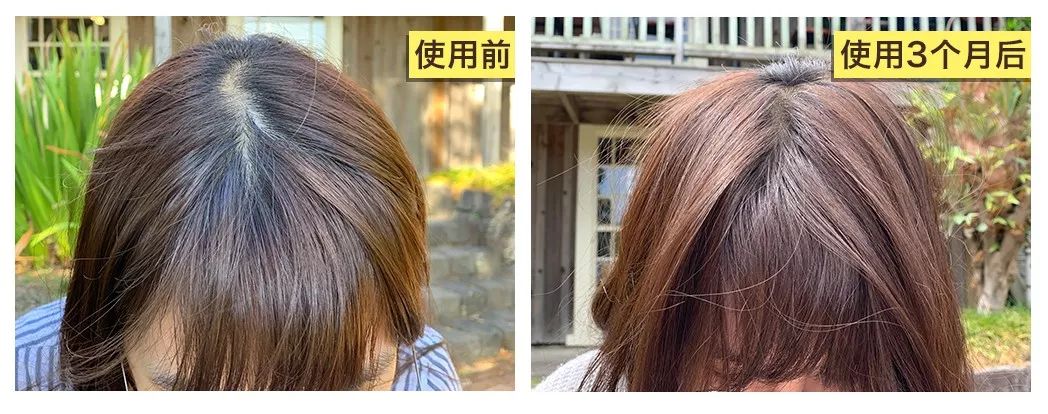 生发长头发神器,脱发生发最新科技