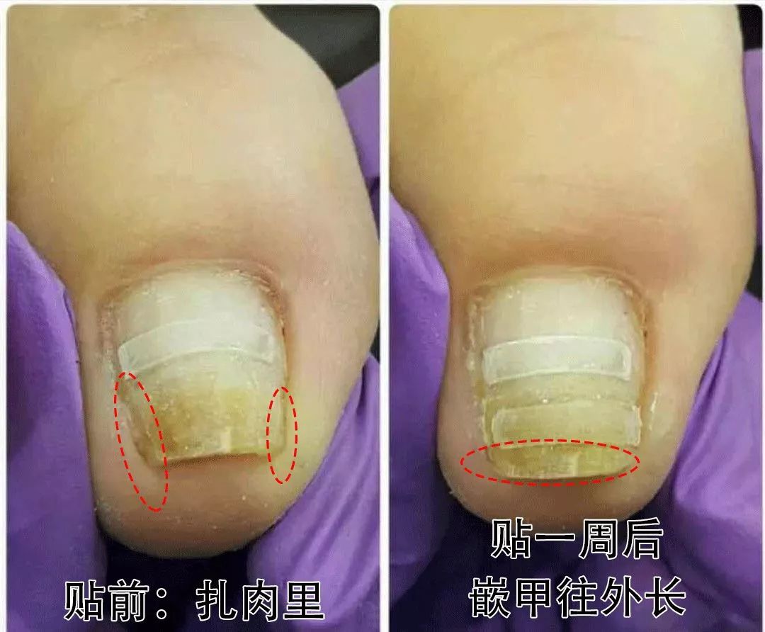 趾甲扎进肉里了，一碰就痛？用它一贴，1分钟止痛，趾甲往外长，再也不扎痛了！