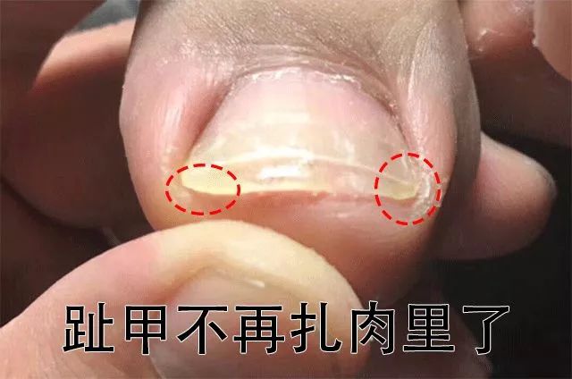 趾甲扎进肉里了，一碰就痛？用它一贴，1分钟止痛，趾甲往外长，再也不扎痛了！