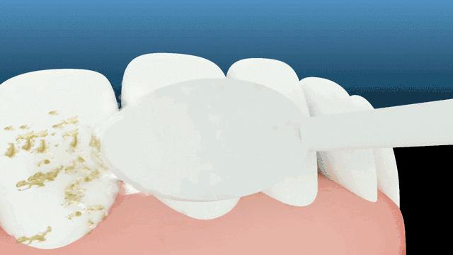 去除黄牙牙垢的牙膏,去口臭黄牙牙垢的牙膏