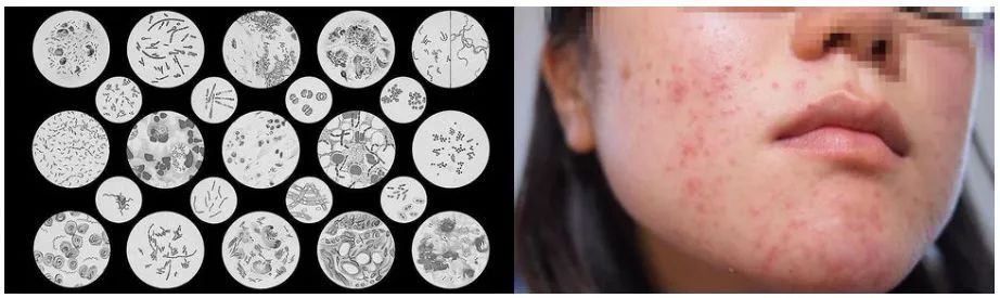 战痘神器祛痘效果怎么样,战痘神器推荐