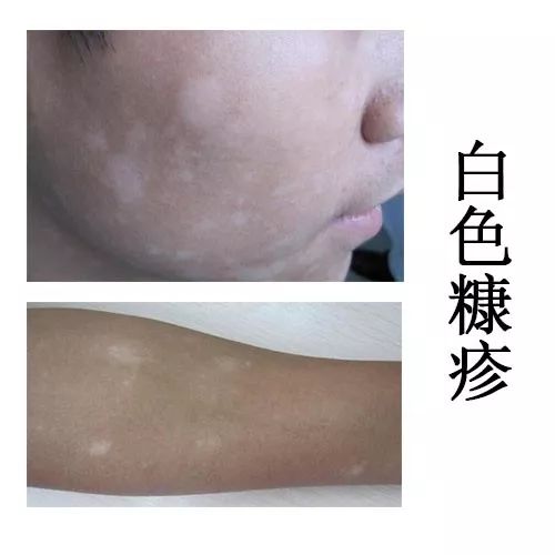 脖子突然出现白斑是不是白癜风,身上长白斑是白癜风吗如何确诊