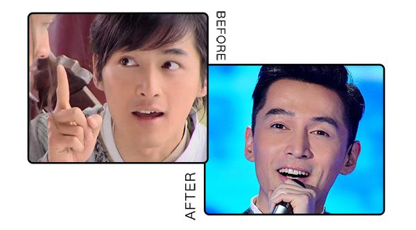 戴牙套整牙的全过程,隐形牙套换头