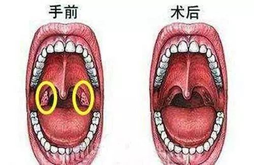 写给被我们割掉的子宫、扁桃体、胆囊、脾、卵巢、阑尾的祭文，割掉后果……