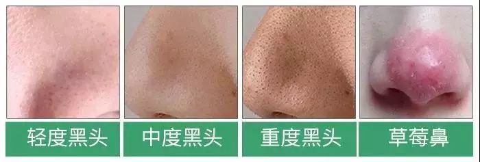 清洁毛孔|又爽又恶心的去黑头方法来了！5分钟将你10年的黑头白头连根拔起