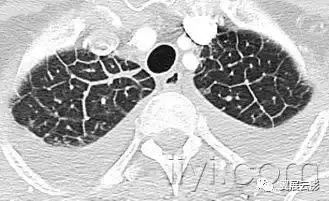 胸部解剖及常见疾病影像表现,胸部影像学基础知识
