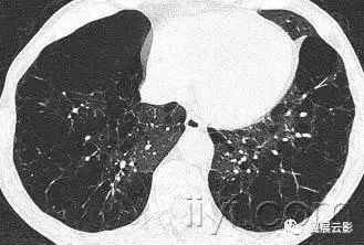 胸部解剖及常见疾病影像表现,胸部影像学基础知识
