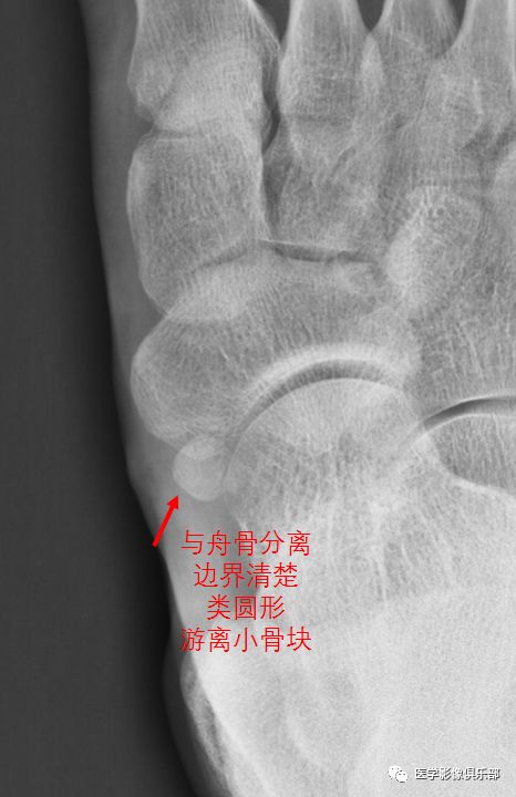 足副骨综合征,副舟骨疼痛综合征