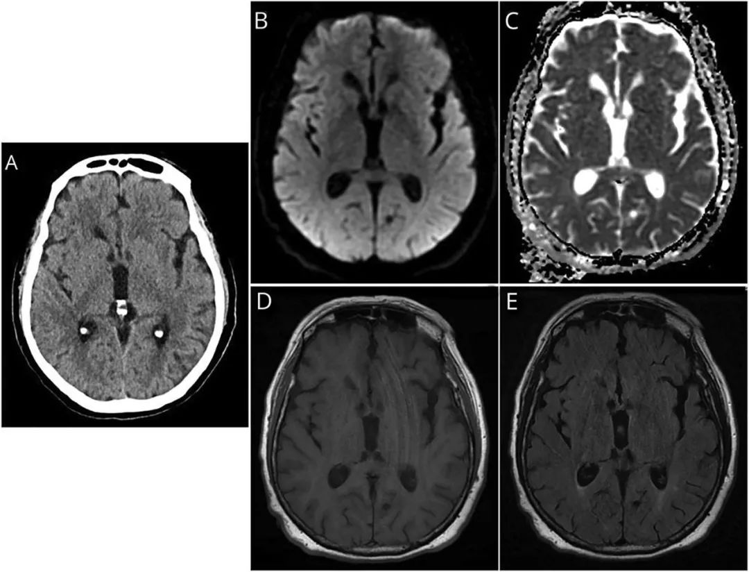 得了新型隐球菌性脑膜炎多久发病,隐球菌脑膜炎治疗后持续头晕