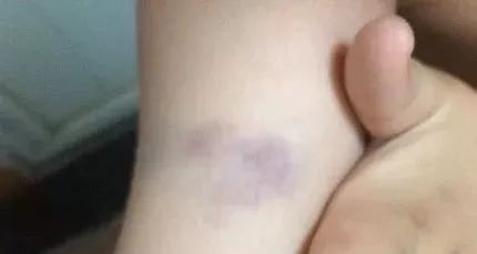 身上出现淤青如何解决,身体淤青千万不要大意