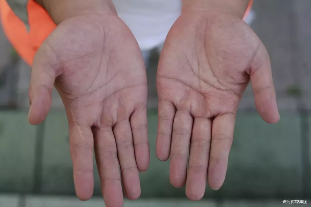 双手起满老茧的男孩,17岁男孩长了手上老茧