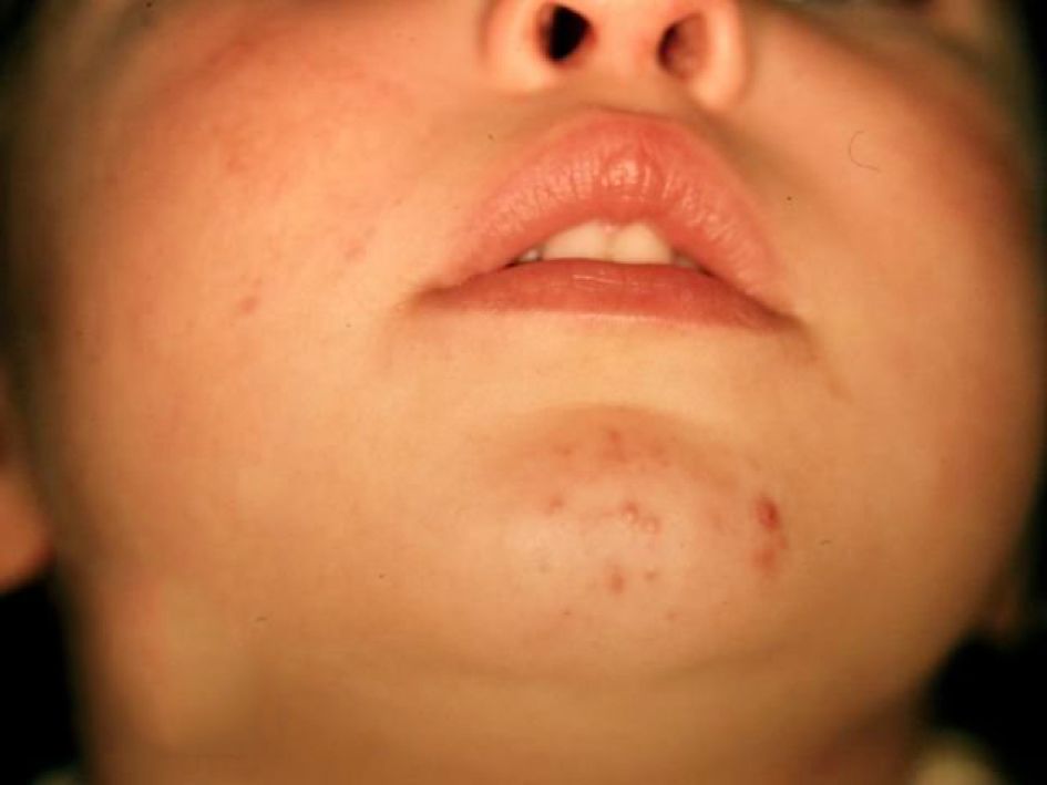 哪种皮肤病容易被误判为银屑病,容易被误诊为疥疮的皮肤病